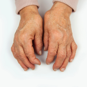 Rheumatoide Arthritis